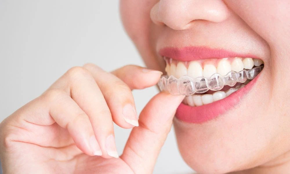 Aligners