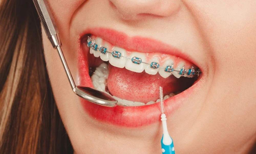 Braces